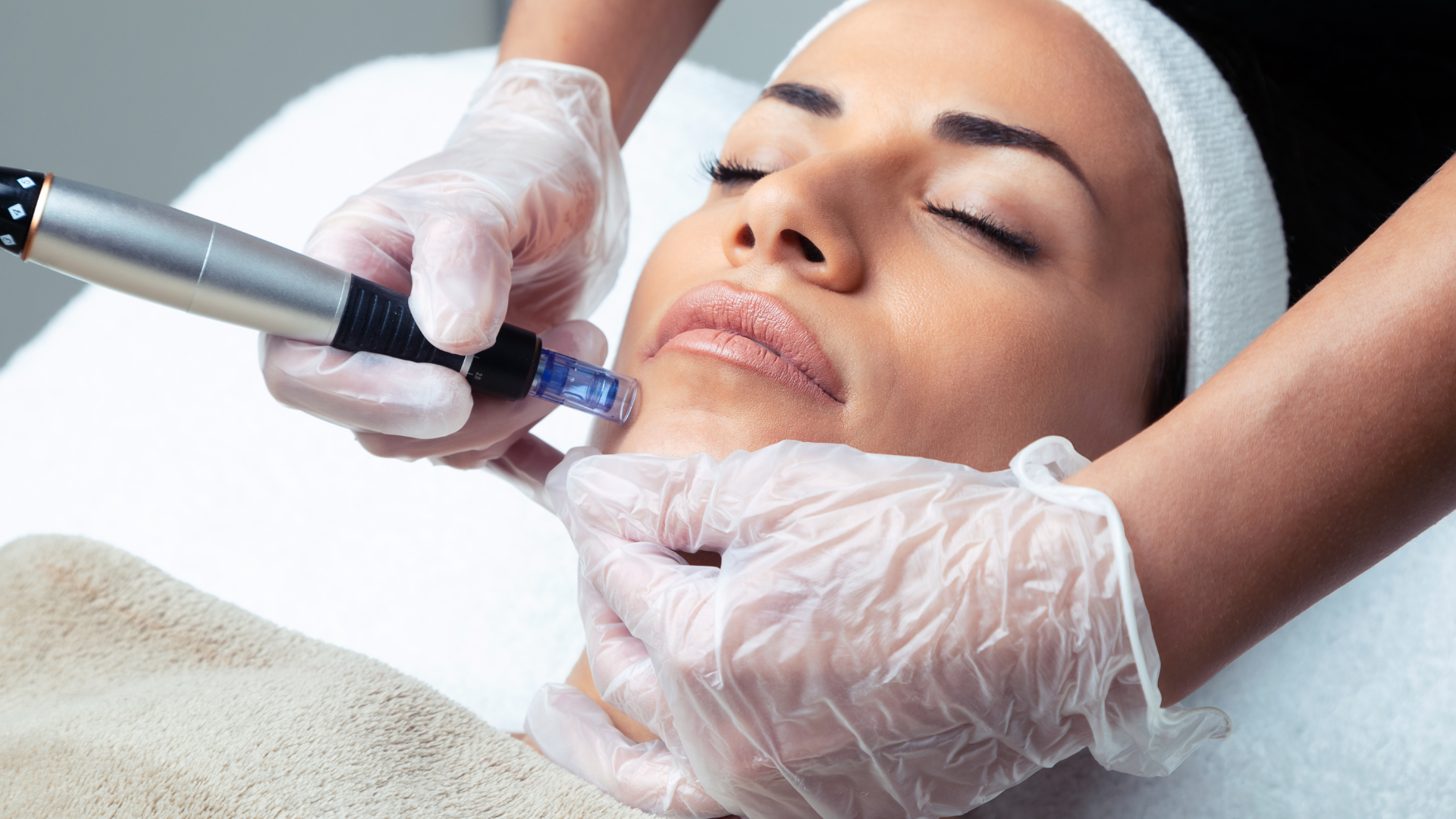 Microneedling procedure. 