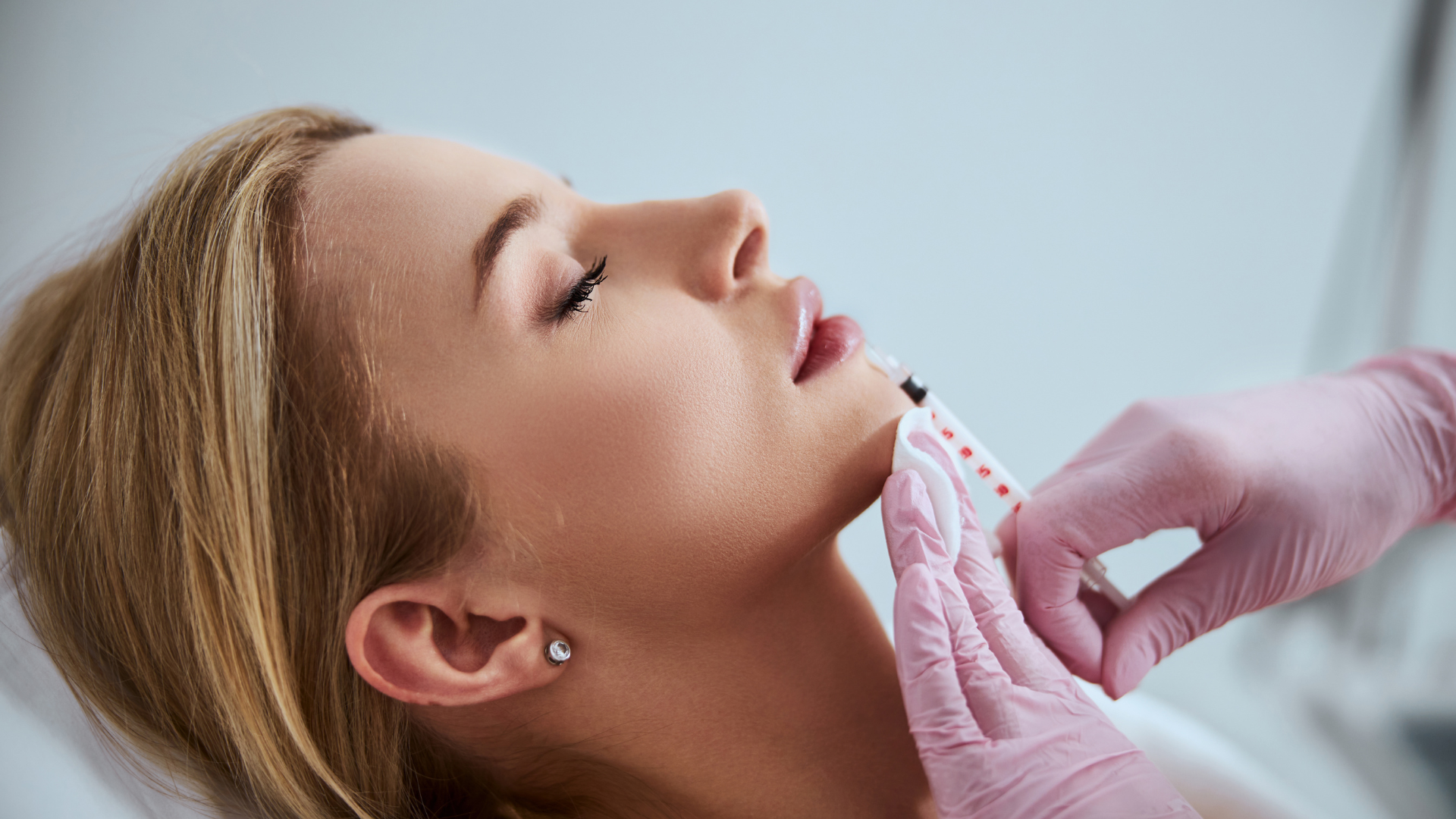 Teosyal filler treatment.
