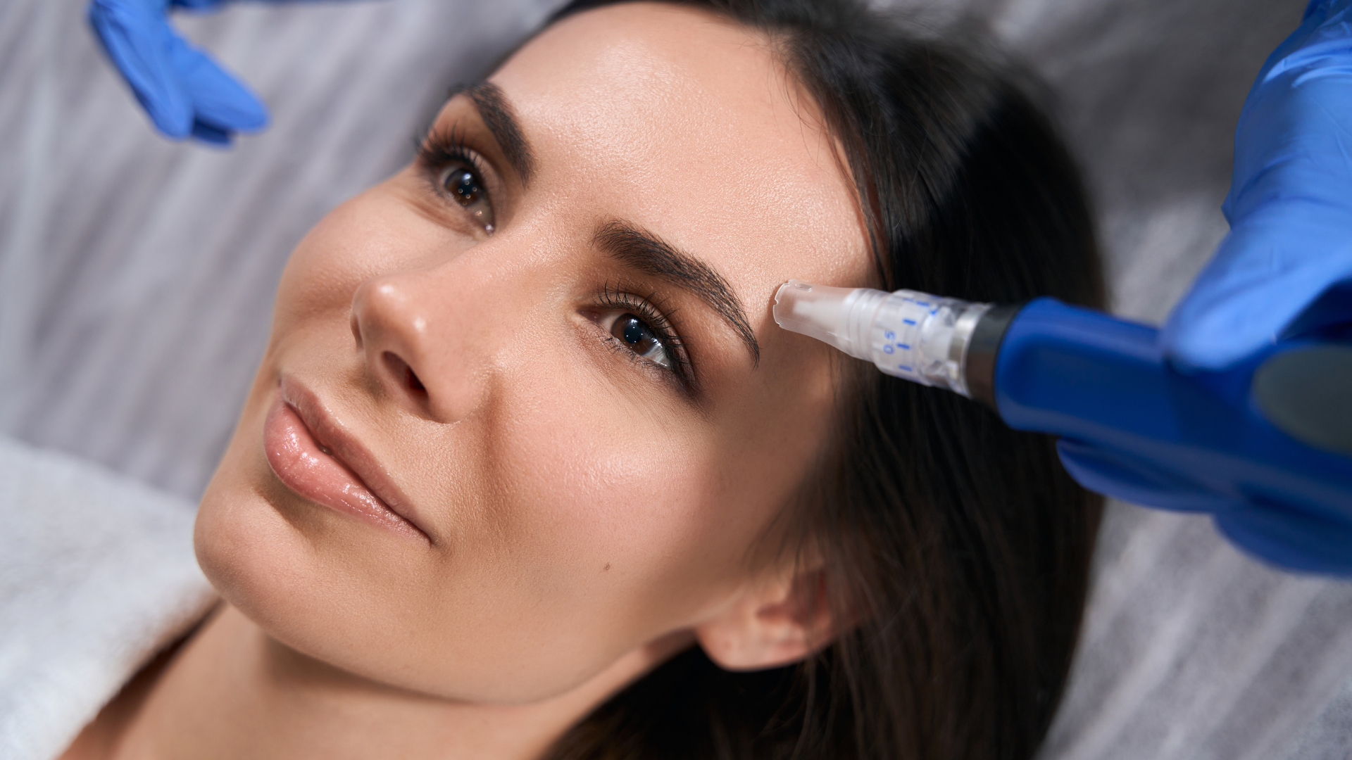 Microneedling procedure. 