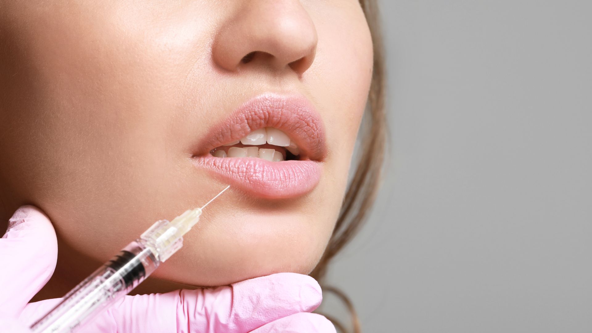 Teosyal filler treatment.