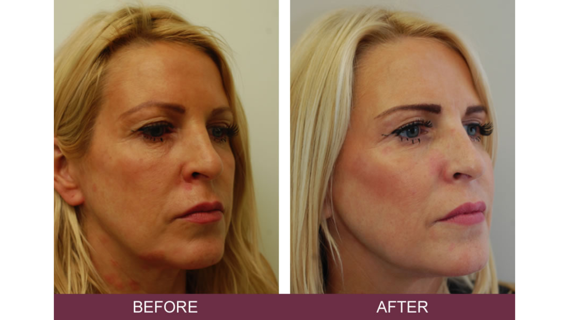 Before and after treatment.