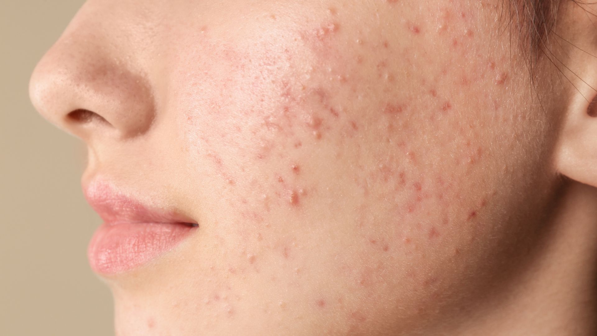 Acne. 
