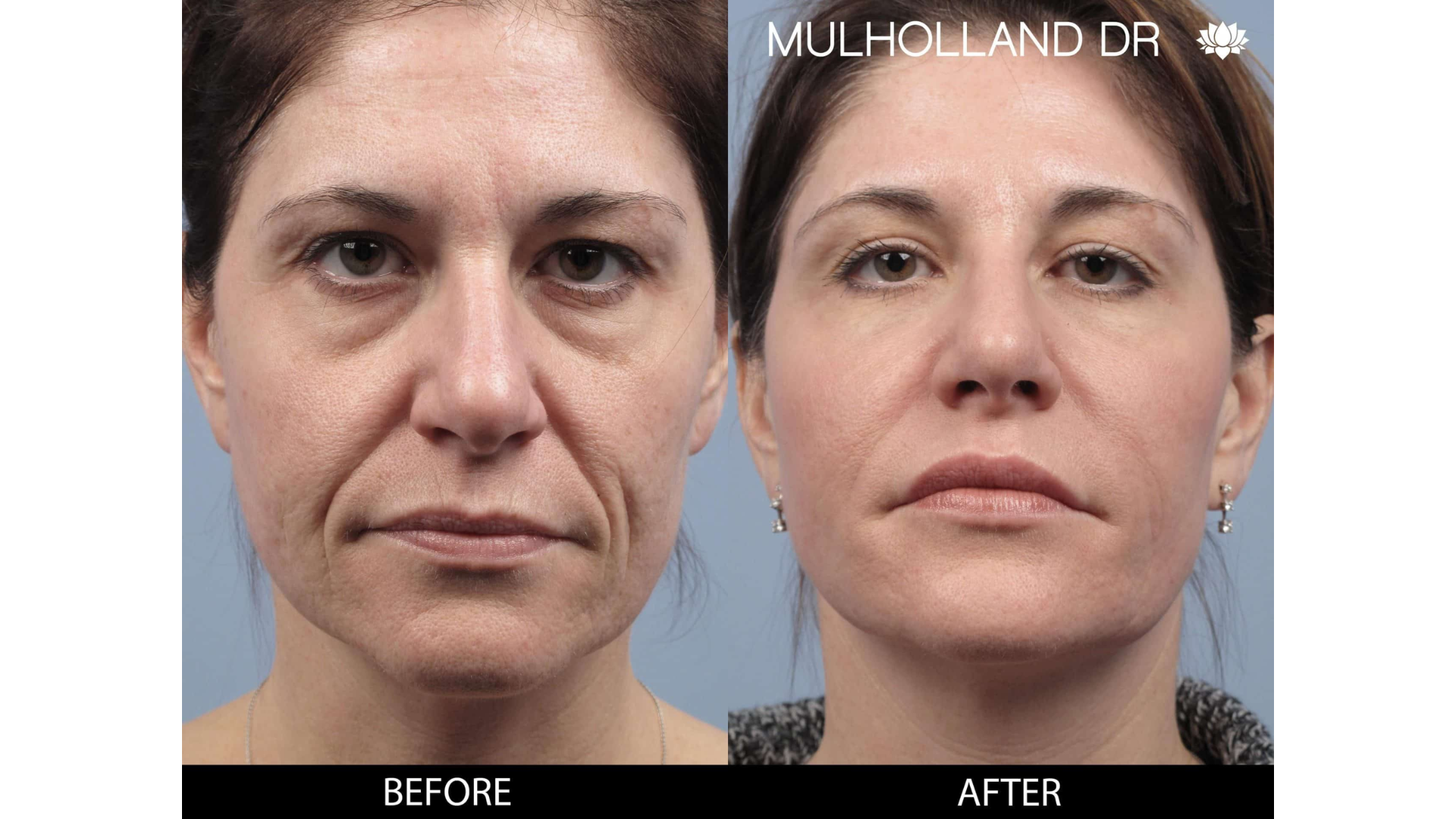 Before and after teosyal treatment.