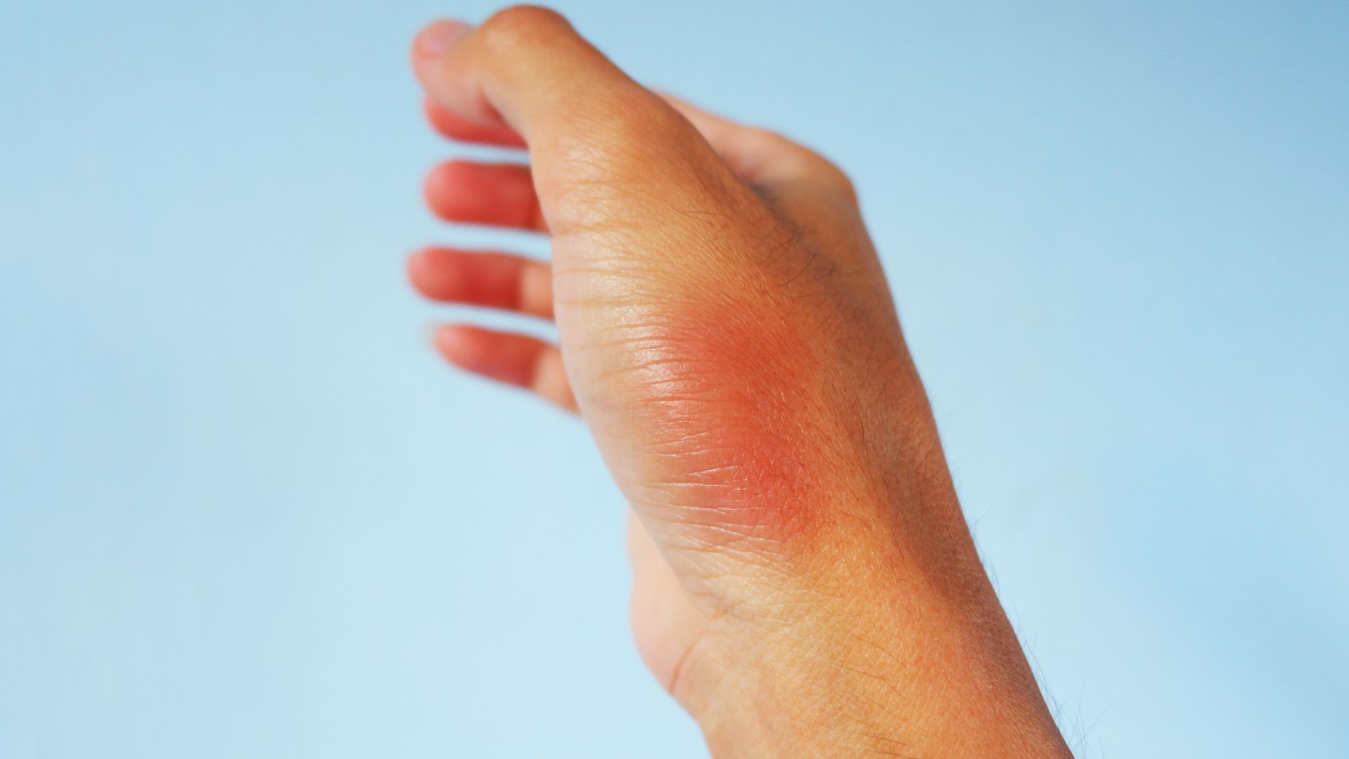 Bruise. 