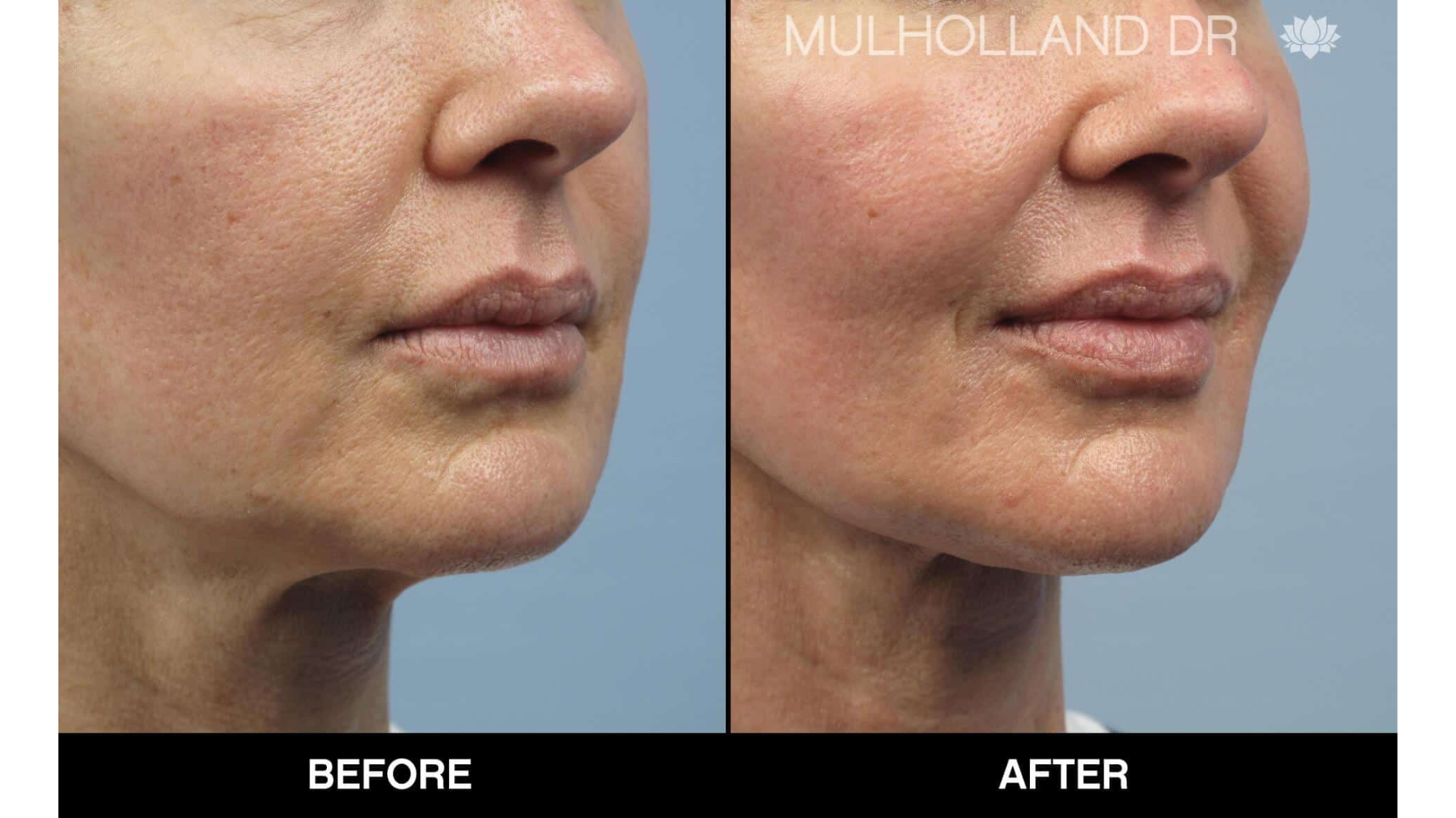 Before and after teosyal treatment.