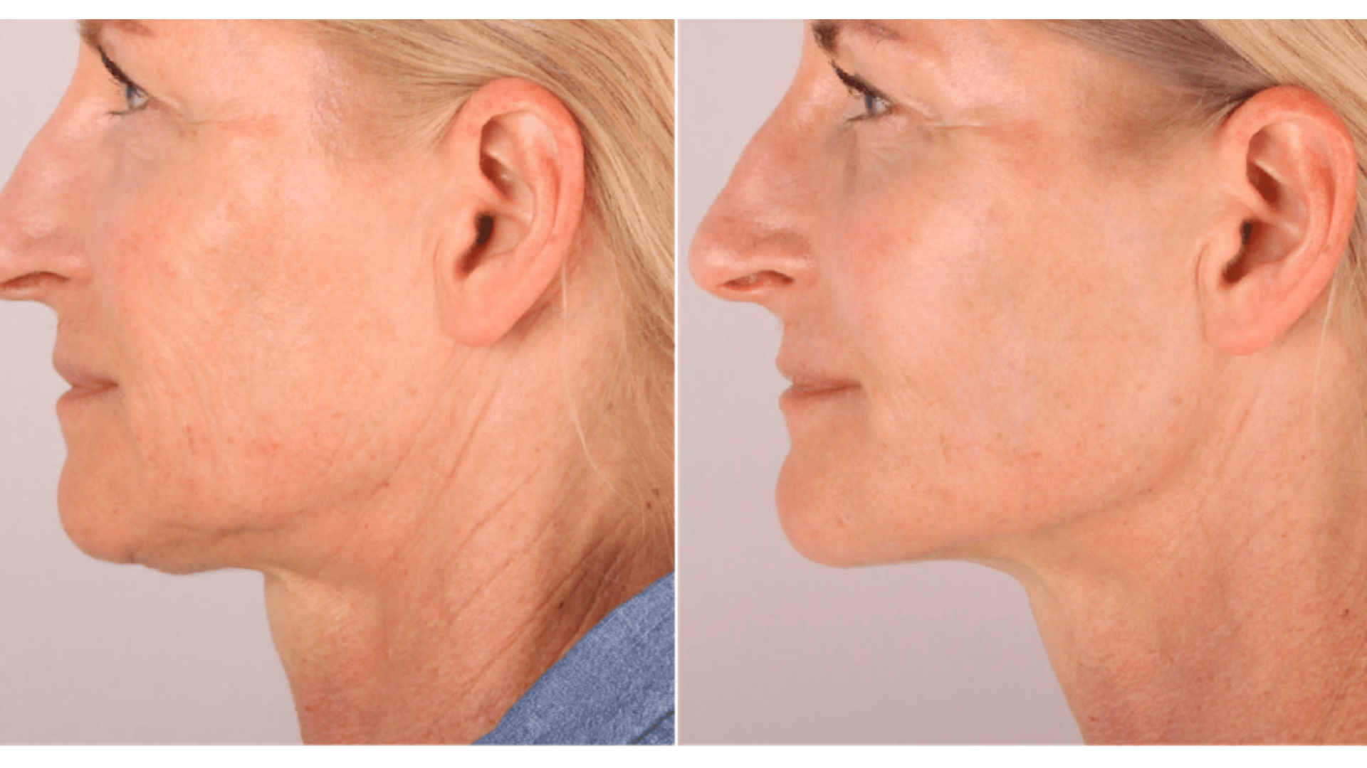 Radiesse Neck Before And After With Photo Examples Medical SPA RX Radiesse Neck Before And After With Photo Examples Medical SPA RX