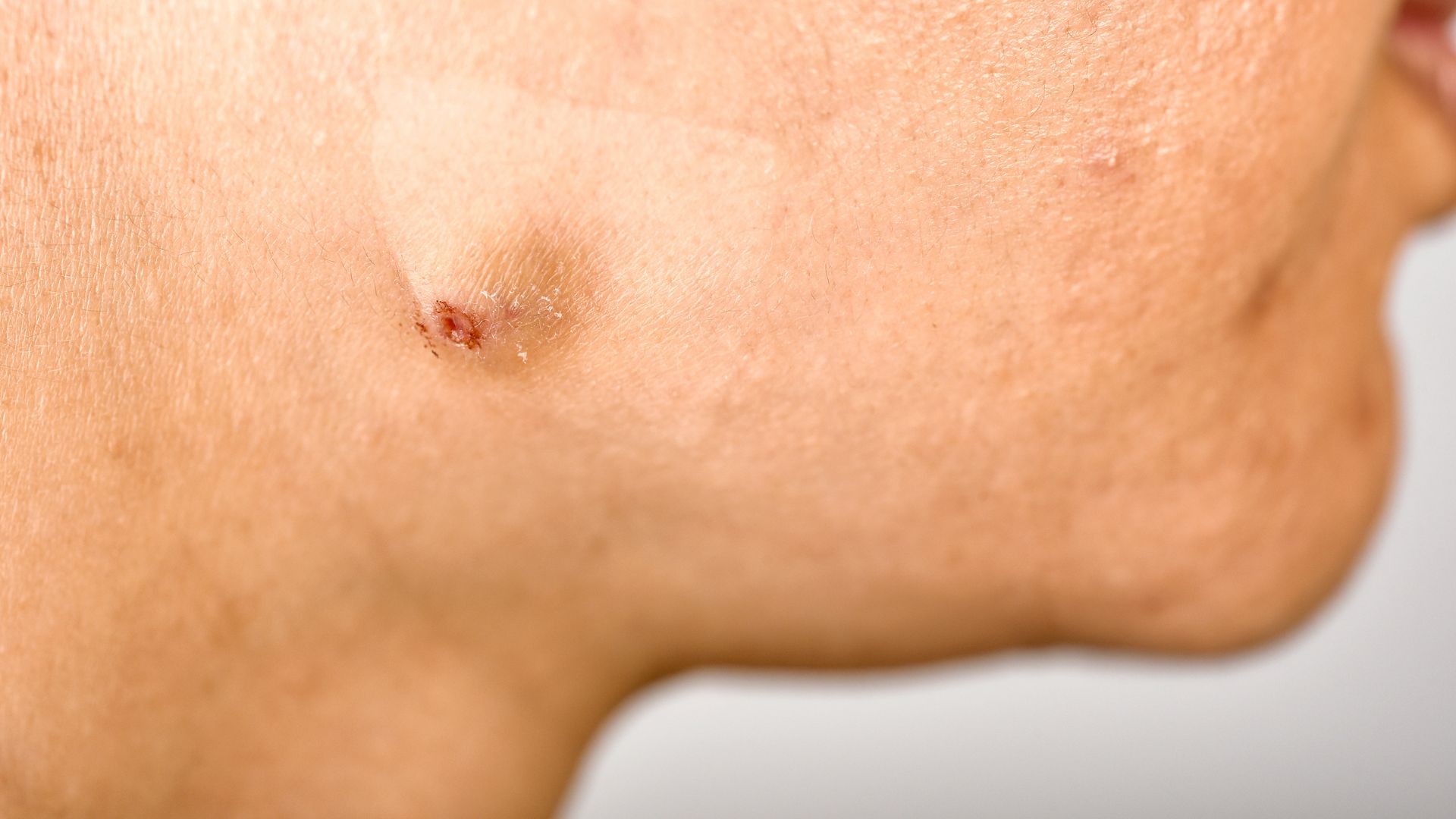 Nodule. 