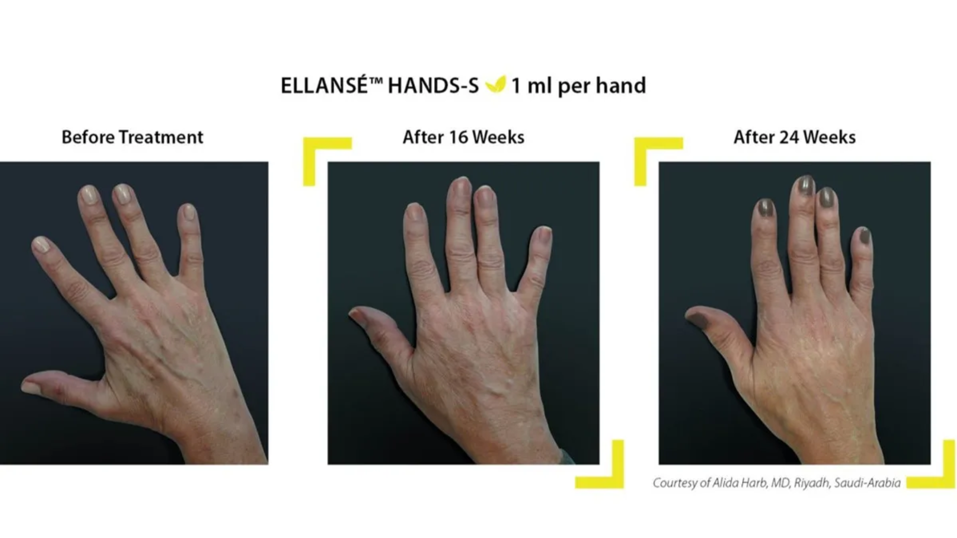 Before and after of treatment.