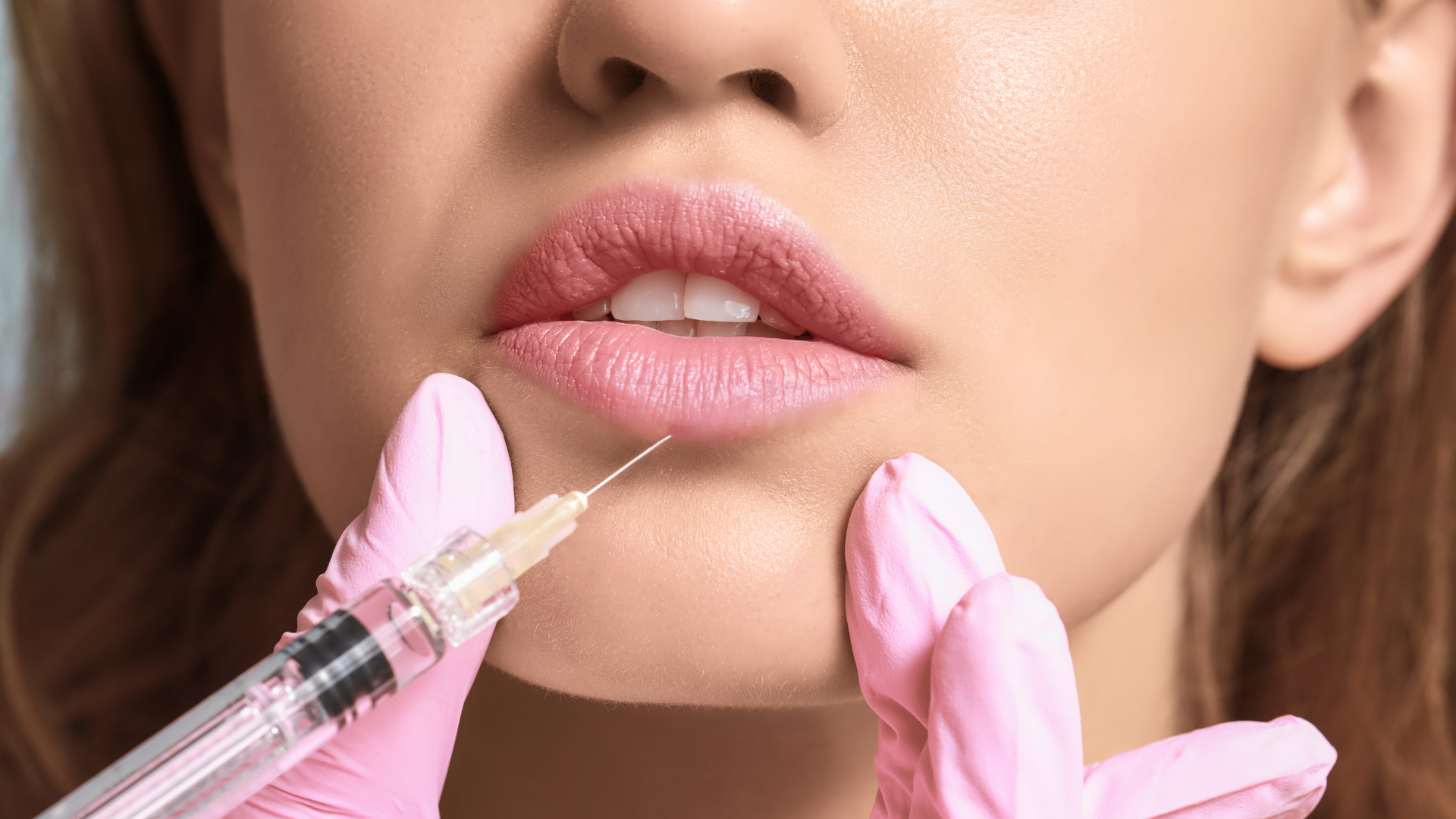 Teosyal filler treatment.