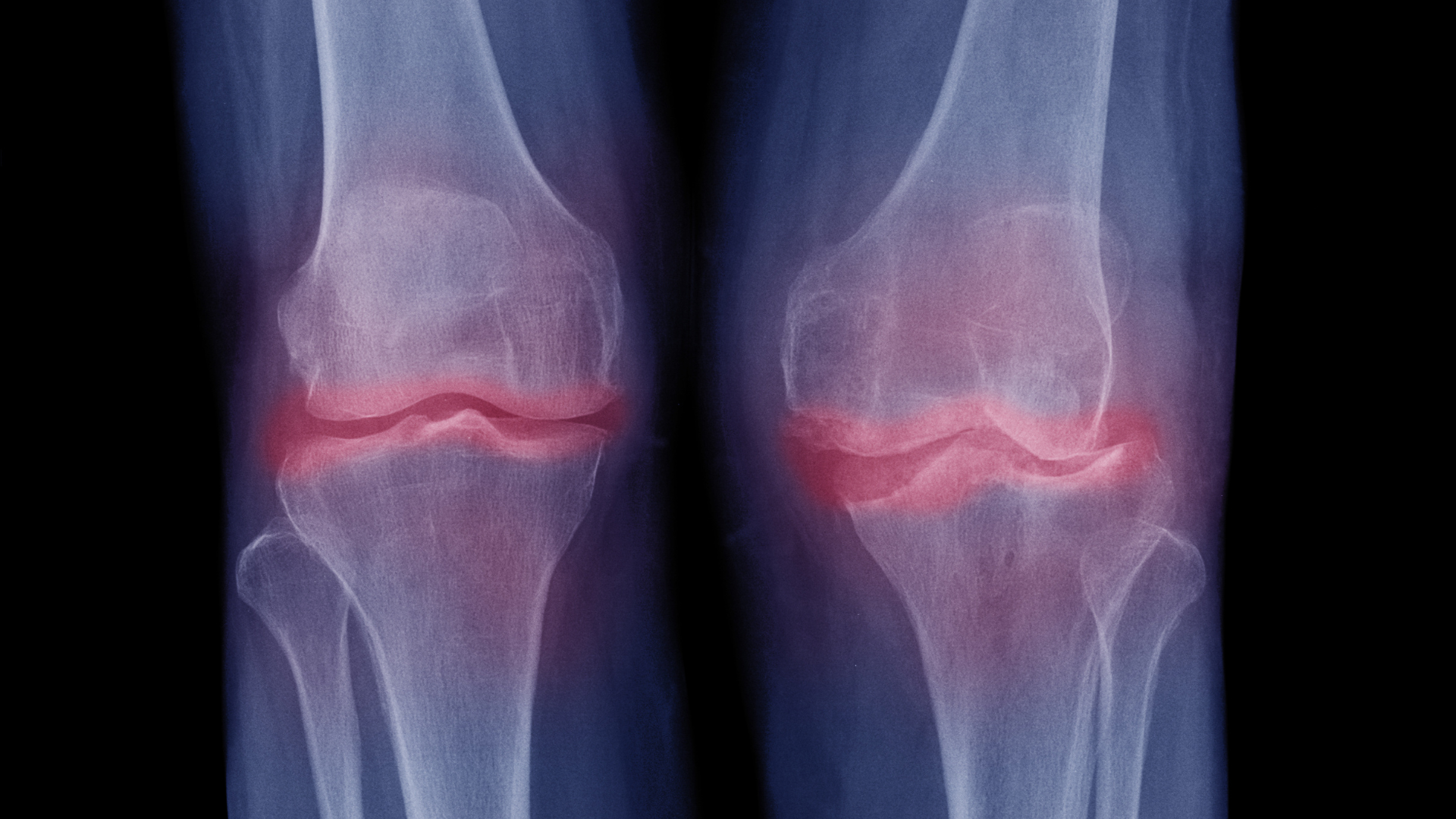 Knee pain.