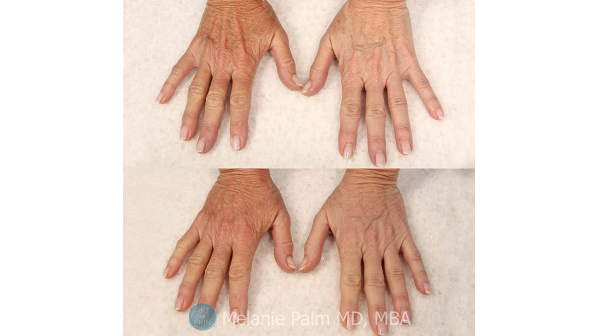 Before and after of hand rejuvenation. 