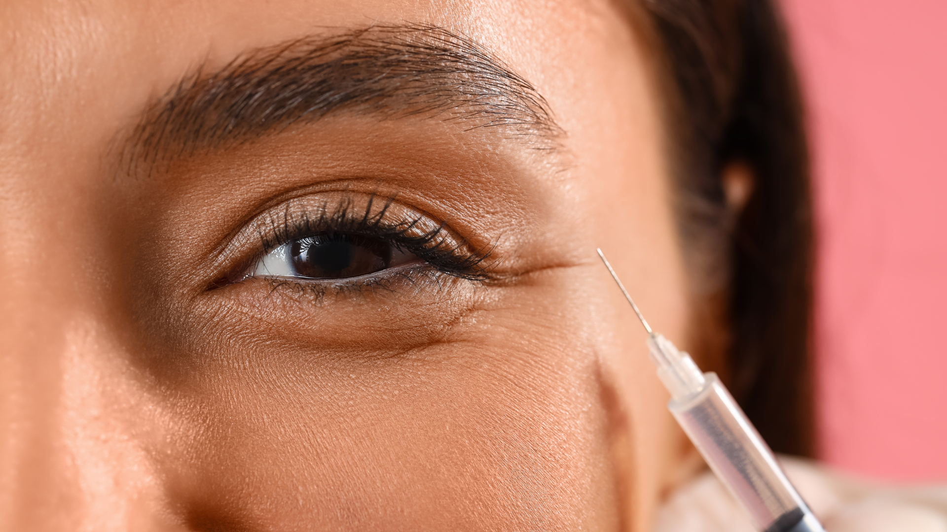 Teosyal filler treatment.