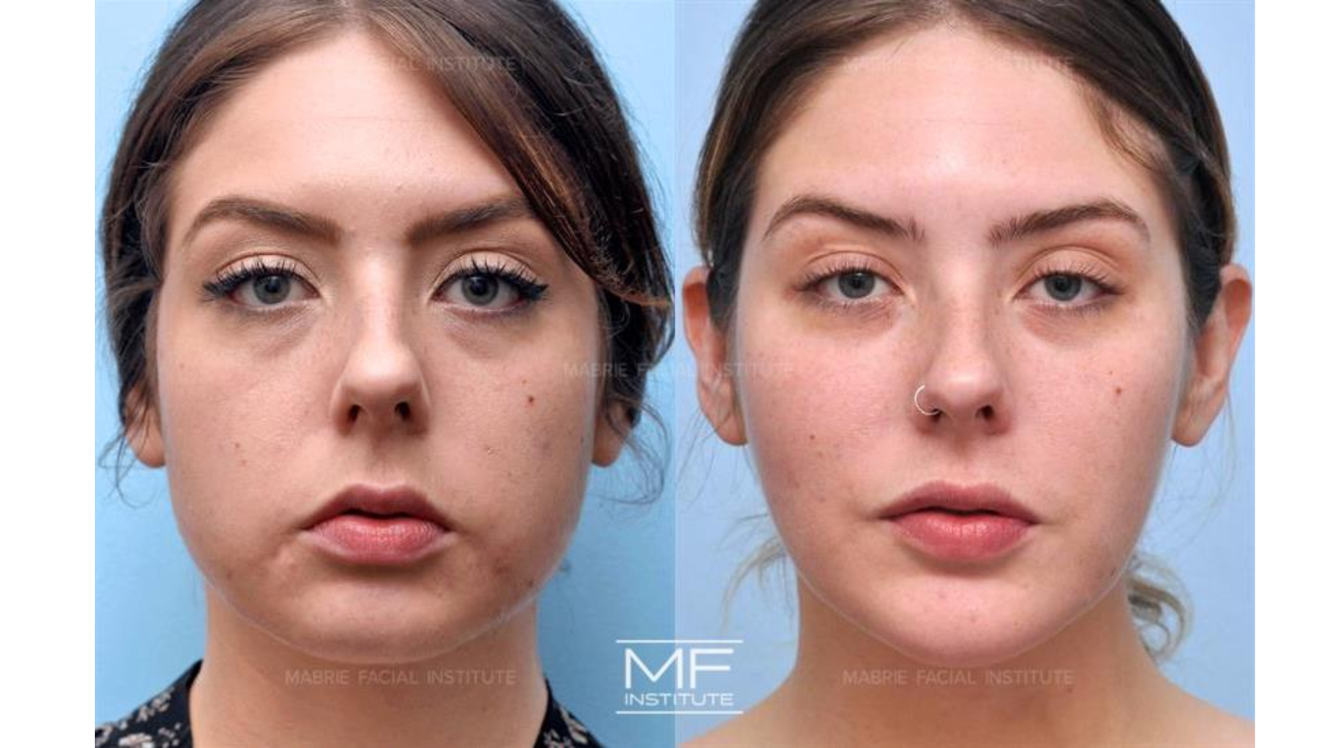 Before and after of treatment.