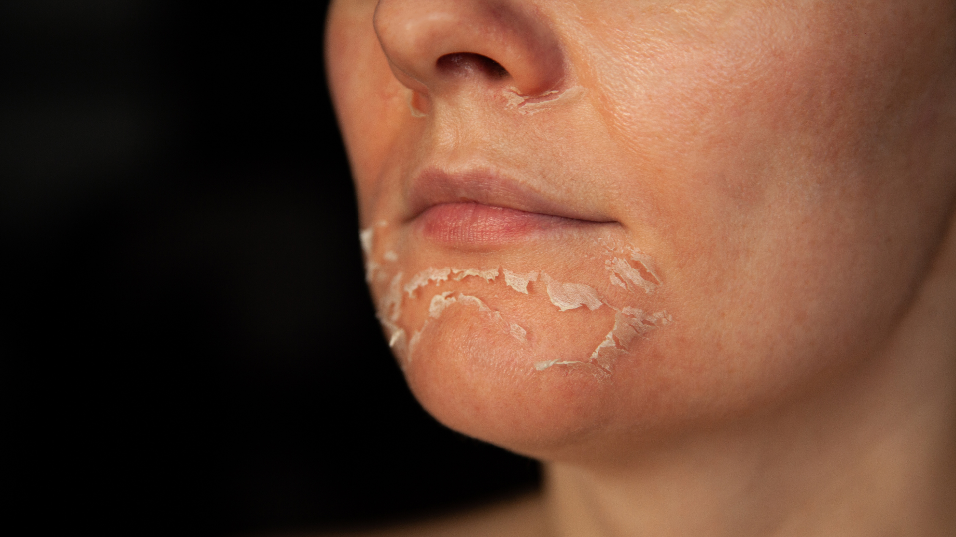 Peeling. 