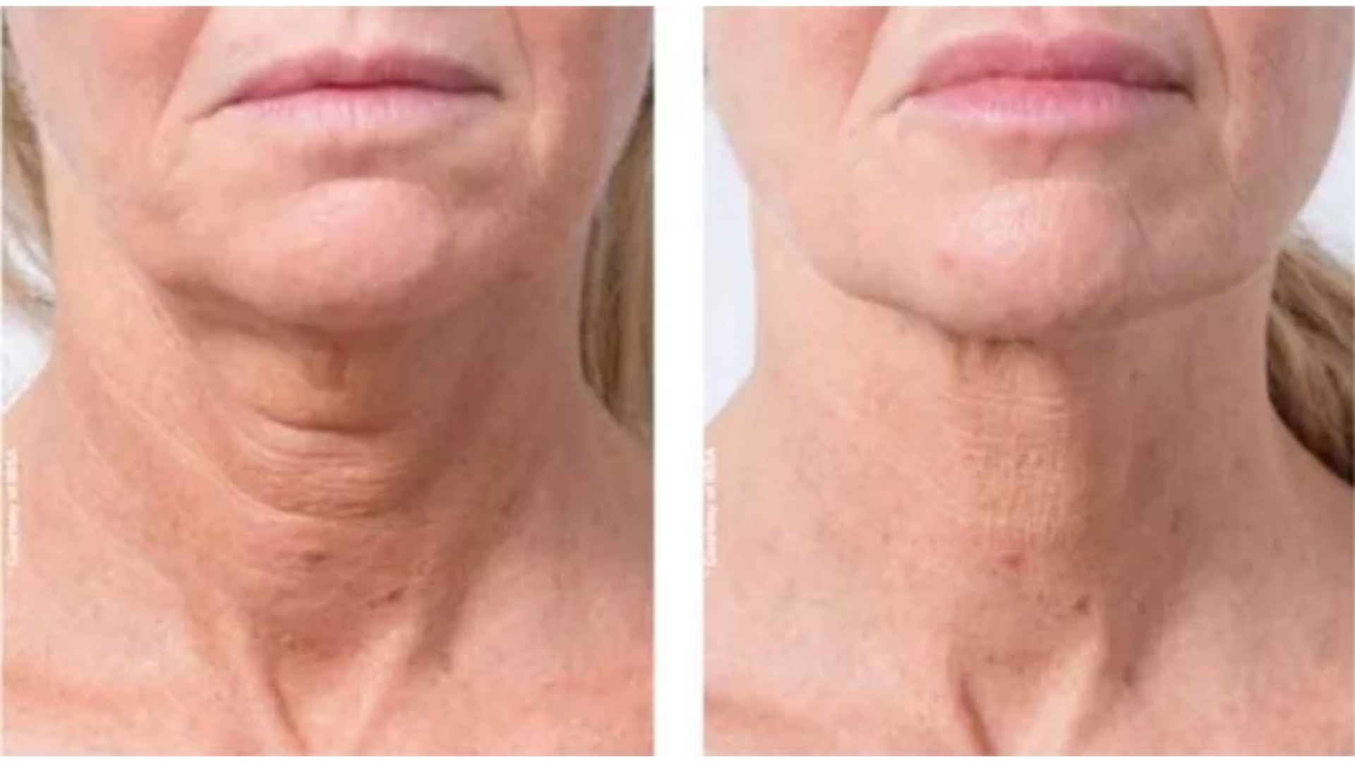 Before and after of neck procedure.