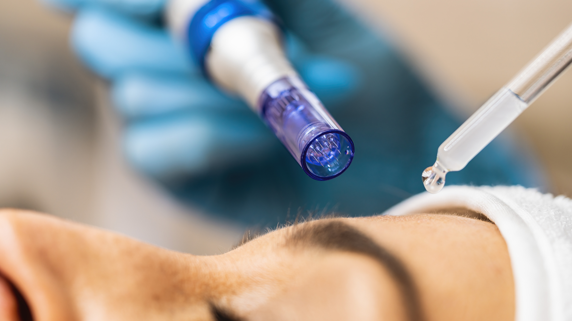Microneedling procedure. 