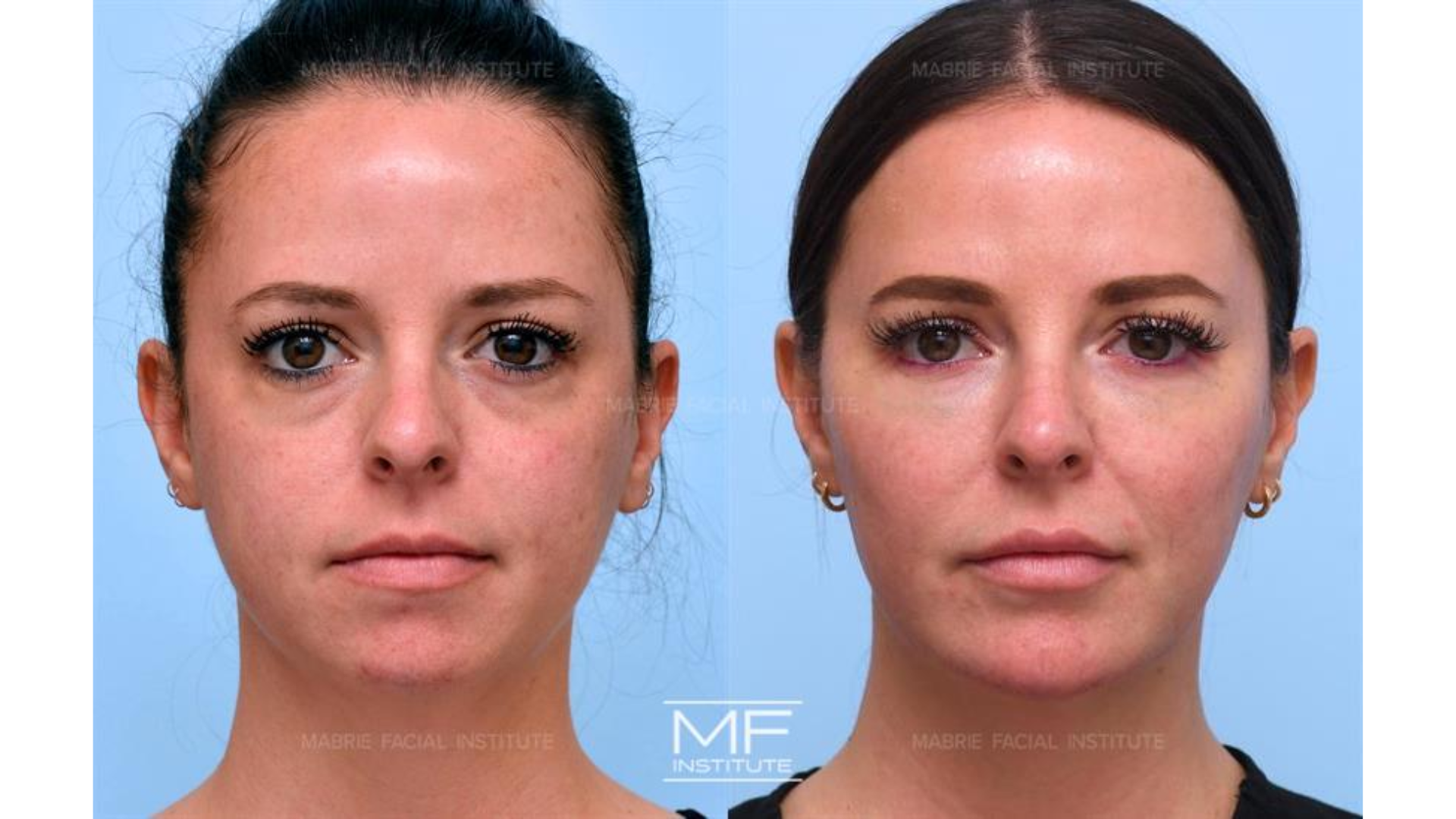 Before and after of treatment.