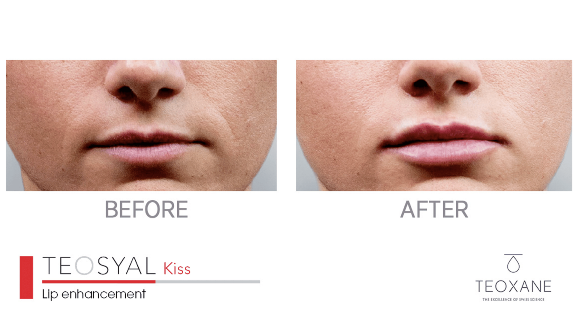 Before and after Teosyal filler treatment.