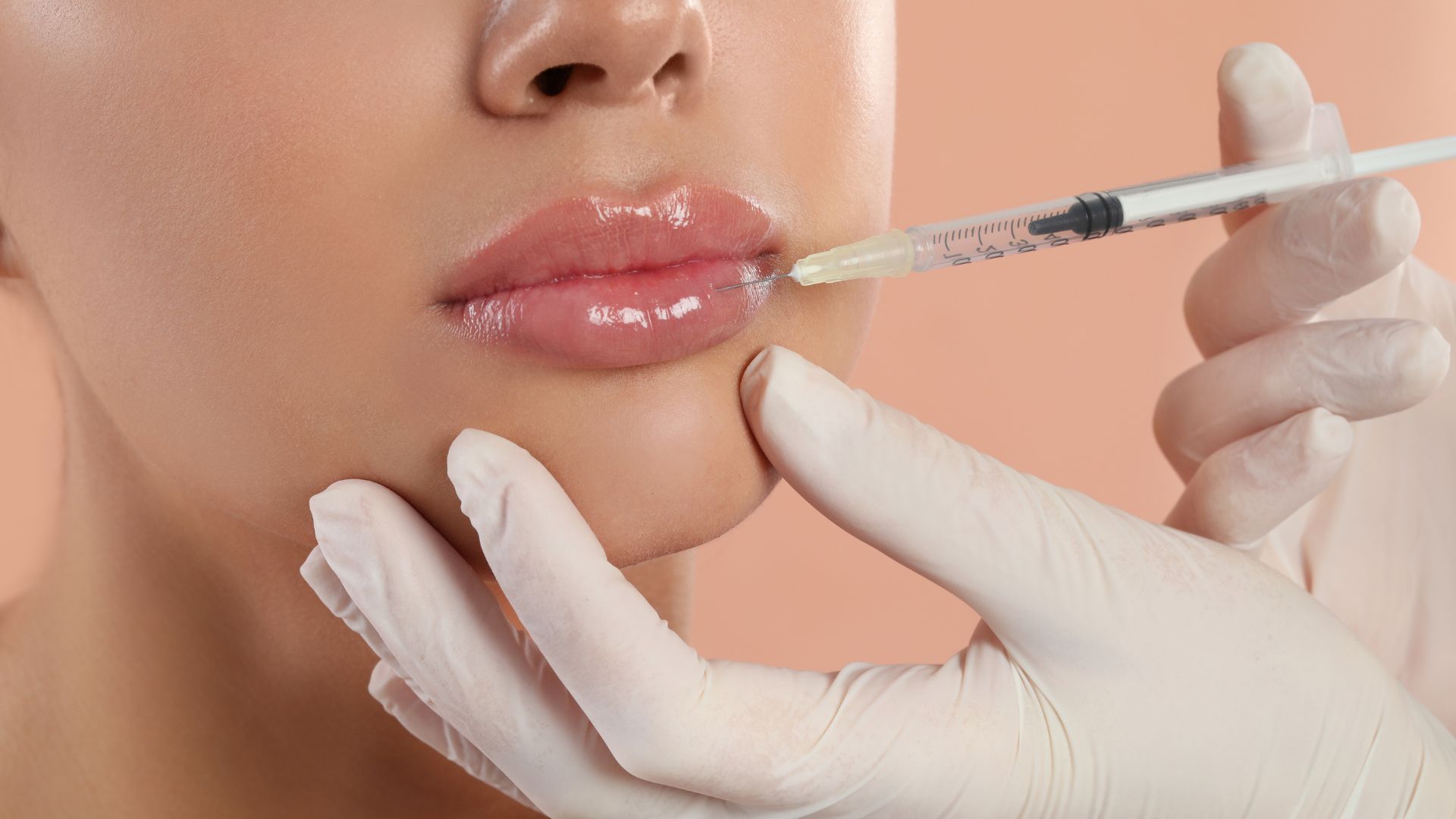 Radiesse treatment.