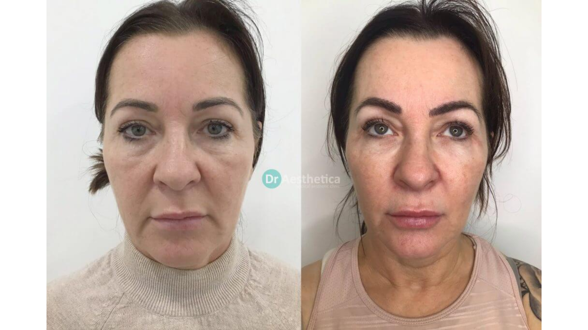 Before and after. 