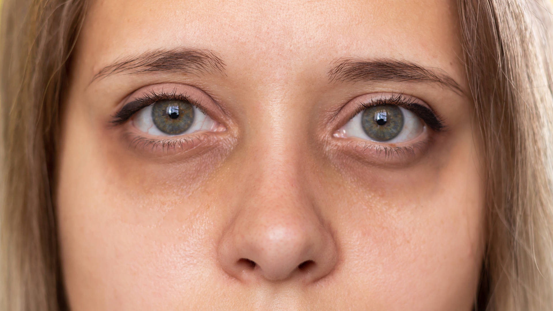 Hollow eyes. 