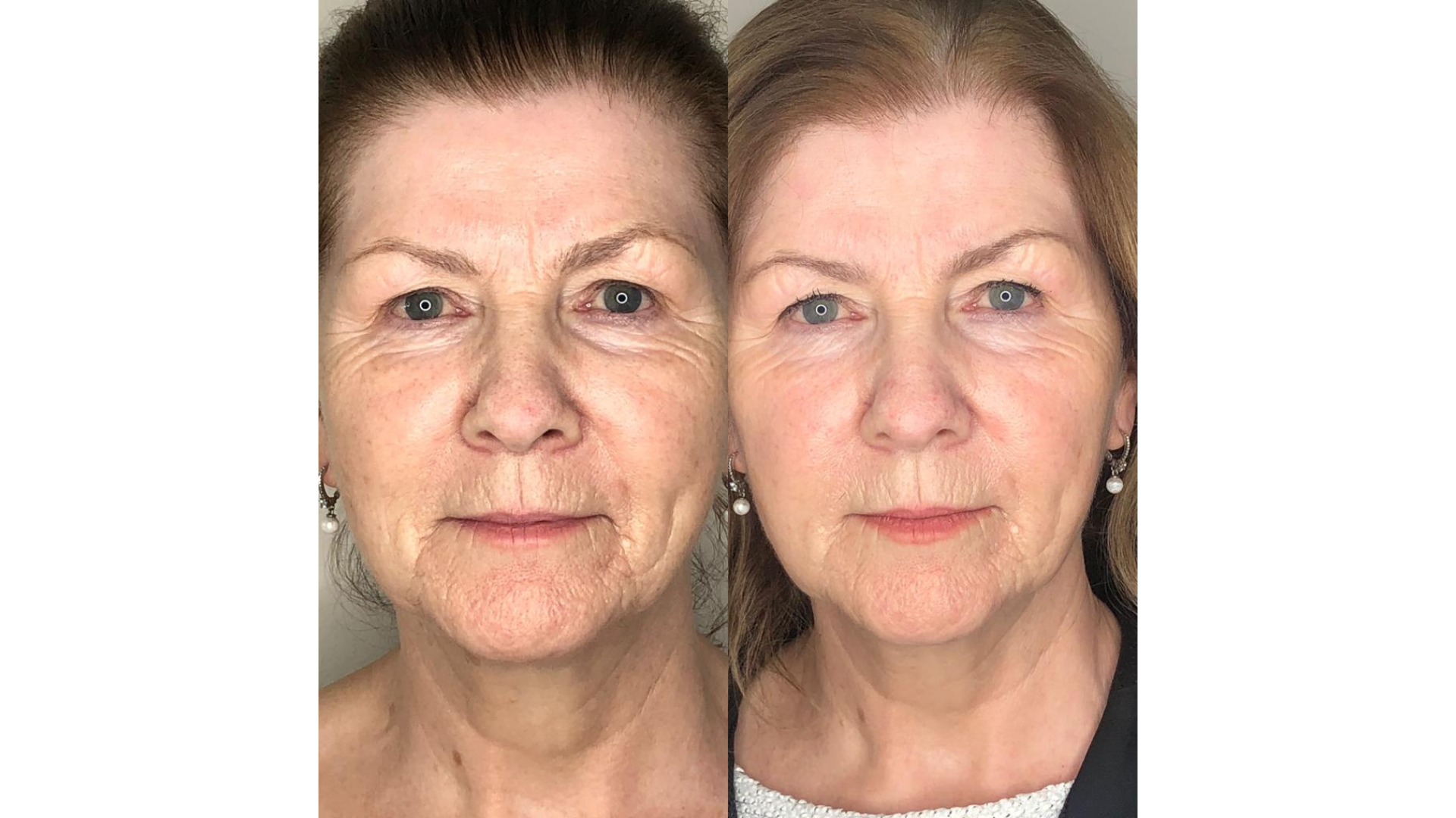 Before and after of Skin treatment.