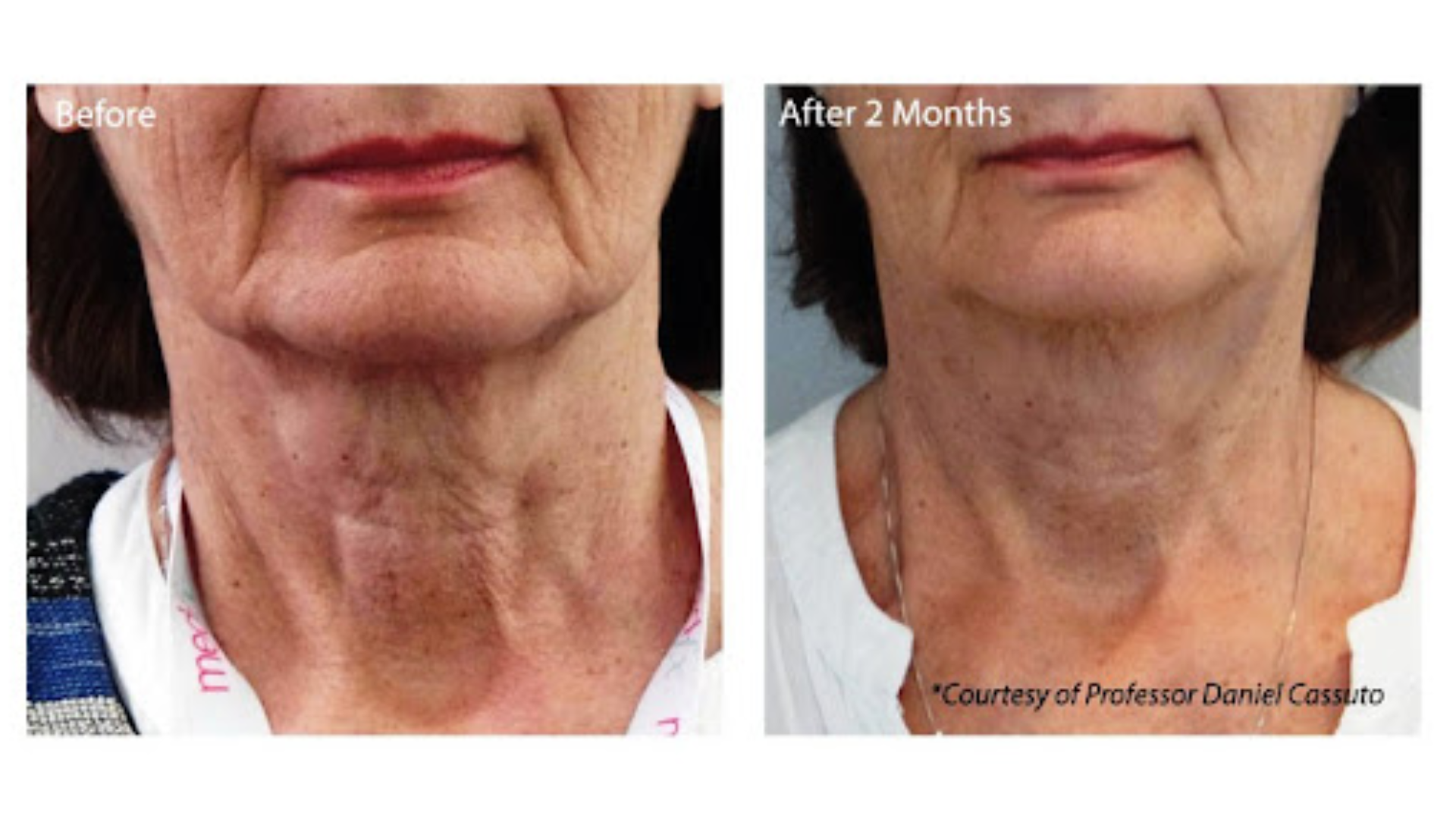 Before and after of neck procedure.